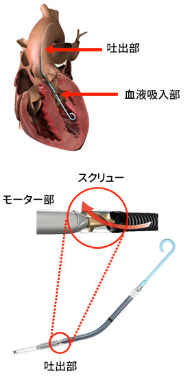 画像提供:日本アビオメッド株式会社