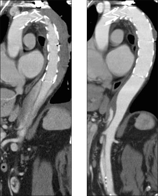 (左)術後1週間、胸部解離腔はすでに血栓化<br>(右)術後4ヶ月、胸部解離腔は消退し、真腔も拡大